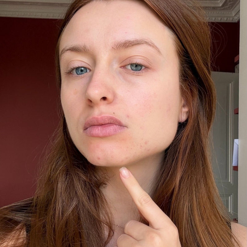 LA SYMBOLIQUE ÉMOTIONNELLE DE L'ACNÉ & DES IMPERFECTIONS
