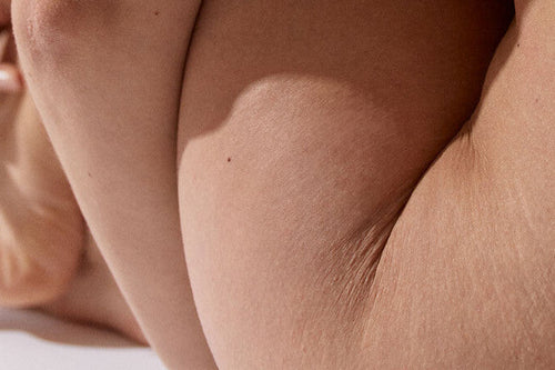 Vergetures - on lève le tabou !