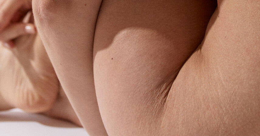 Vergetures - on lève le tabou !